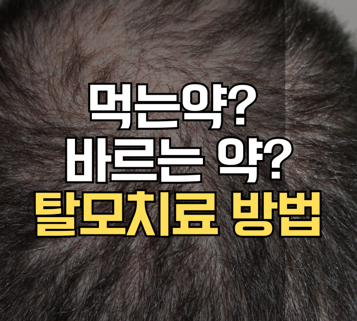 탈모치료 방법